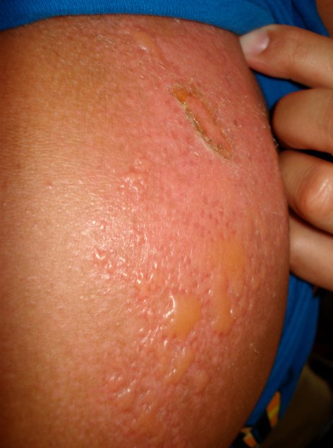 This image shows a second-degree burn on an upper arm, caused by a sunburn. The flesh is very pink and there is yellowish blistering.