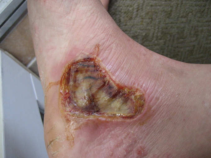 This image shows an oval-shaped fourth-degree burn above the heel on the inside of the foot. The outer areas are brown, while the inside of the burn is yellow.