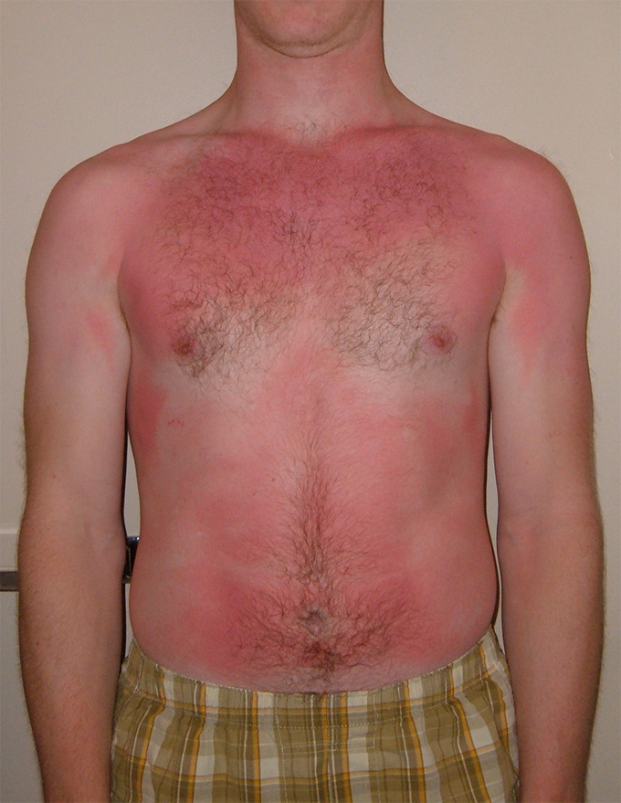 This image shows a man's chest. It is very pink due to a minor sunburn.