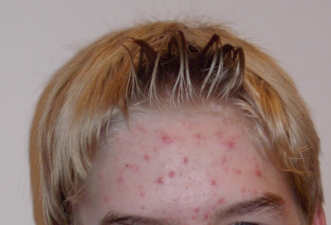 This image shows a 14-year-old male with with acne on his forehead. Many different red pimples, of varying size and severity, dot this person's forehead.