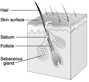 This image shows the sebaceous gland, hair follicle, sebum, skin surface, and hair. The sebaceous gland is deep underneath the skin's surface, adjacent to the hair follicle. The sebum clogs the sebaceous gland and hair follicle, pushing up to the skin surface.