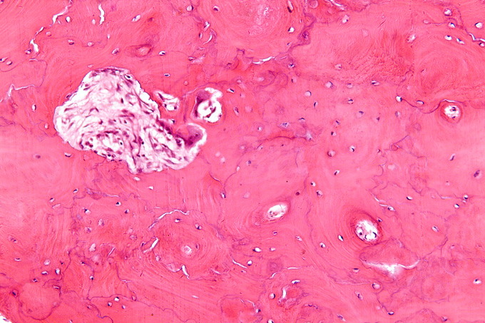 This image is a highly magnified look at a bone with Paget's disease. Intense cellular activity produces the jigsaw puzzle-like pattern shown in this image, rather than the regular linear lamellar pattern in healthy bones.