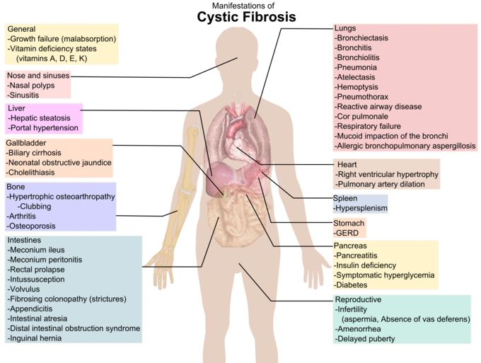 This is a diagram showing manifestations of CF in different parts of the body. For example, manifestation in the stomach is GERD.