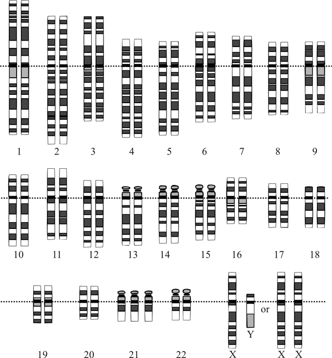 This is a reproduction of a prenatal diagnosis tool that profiles a person's chromosomes, the karyotype. This karyotype indicates that the fetus has Down syndrome as it has three of chromosome 21 instead of two.