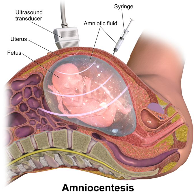 This is an illustration of the amniocentesis procedure. The ultrasound transducer is placed on the womb to create an image on a screen. A schematic of the womb shows the fetus in the uterus, surrounded by amniotic fluid. A syringe is seen drawing out amniotic fluid.