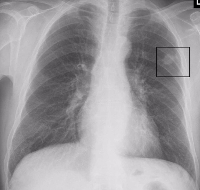 This is a chest x-ray that shows a tumor in the left lung.
