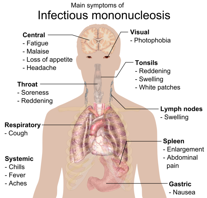 This image contains the main symptoms of mononucleosis according to parts of the body. For example, soreness and redness are the main throat symptoms.