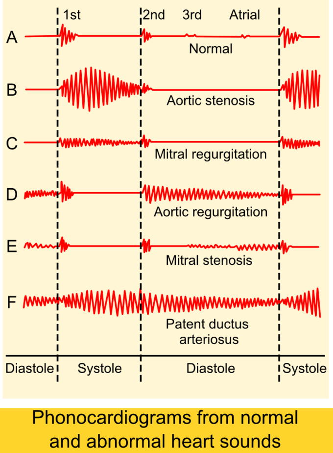 This chart demonstrates the normal and abnormal sounds that heart defects can make.