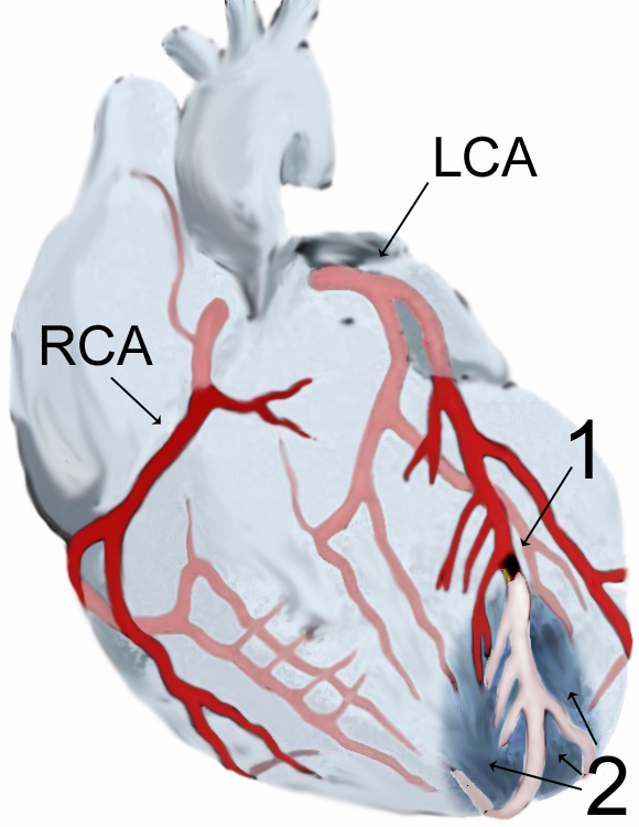 In this image, you can see a blockage of the left coronary artery, which is impeding blood flow.