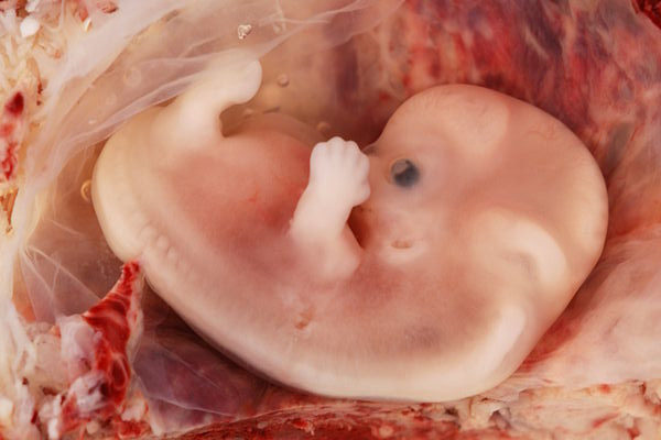 This is a color scan of an embryo from an ectopic pregnancy, located in the part of the uterus to which the fallopian tube is attached. The features are consistent with a developmental age of seven weeks (ninth week of menstrual age).