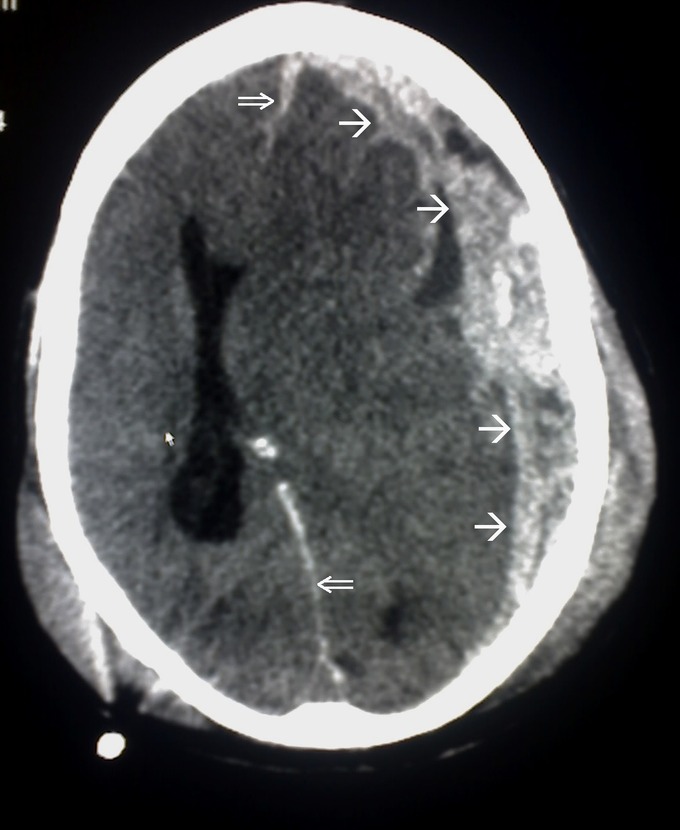 In this image, a subdural hematoma is evident on the right side, which is putting pressure on the brain and shifting the midline from center to the left.