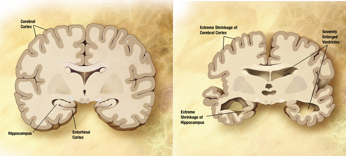 This image shows an image of a healthy brain and an image of a brain with Alzheimer's. In the brain with Alzheimer's, the hippocampus and cerebral cortex have shrunk, and the ventricles are severely enlarged.