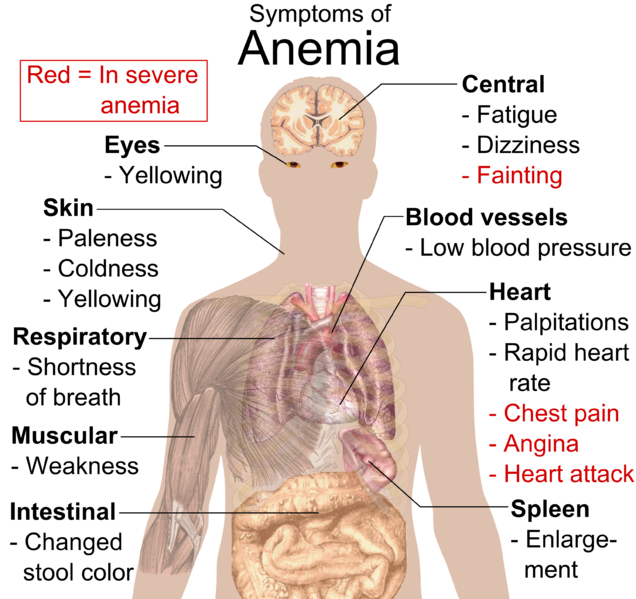 This image displays different parts of the body along with the symptoms of anemia in that part of the body. For example, the symptoms of anemia in the skin are yellowing, coldness, and paleness.