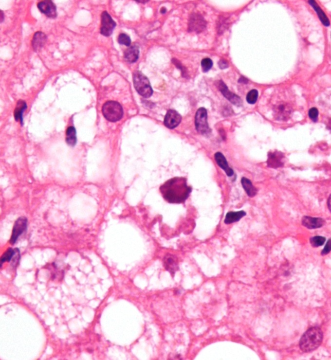 This is a micrograph of an overstressed liver from an alcoholic. A healthy liver can break down alcohol. However, the overstressed liver of an alcoholic may become clogged with fats that adversely affect liver function. This type of tissue is most common in alcoholic hepatitis (a prevalence of 65%) and alcoholic cirrhosis (a prevalence of 51%).