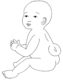 This image is a drawing of an infant with spina bifida. The infant is sitting in profile. You can see a donut-shaped protrusion from the infant's lower back, which is the location of spina bifida.
