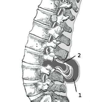 This image shows a drawing of a spinal cord affected by spina bifida. There is a line of vertebrae, and in the middle, exposed spinal cord (which looks like threads) in a cerebrospinal fluid sac between two vertebrae.