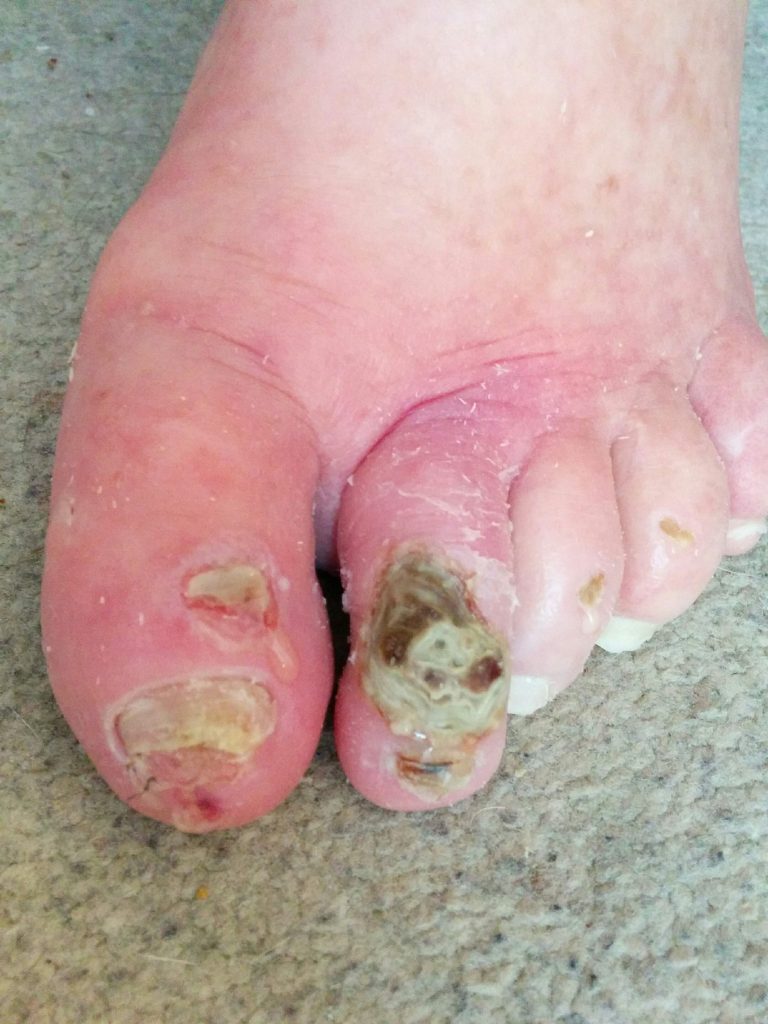 Photo showing Wounds on the Foot of a Client With Diabetes