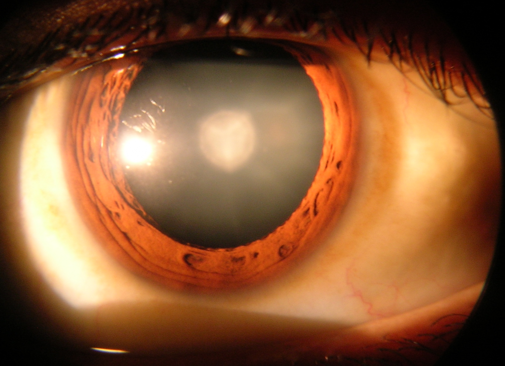 Photo showing Simulated Image of a Cataract