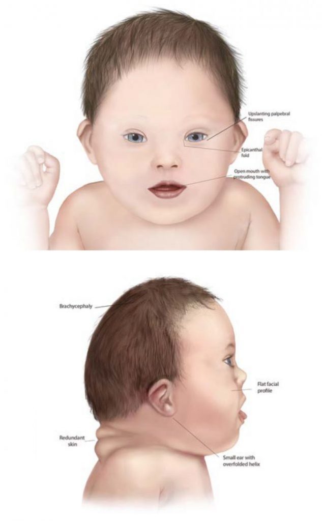Illustrations showing Infant With Down Syndrome