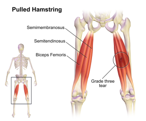 Pulled_Hamstring-300x250.png