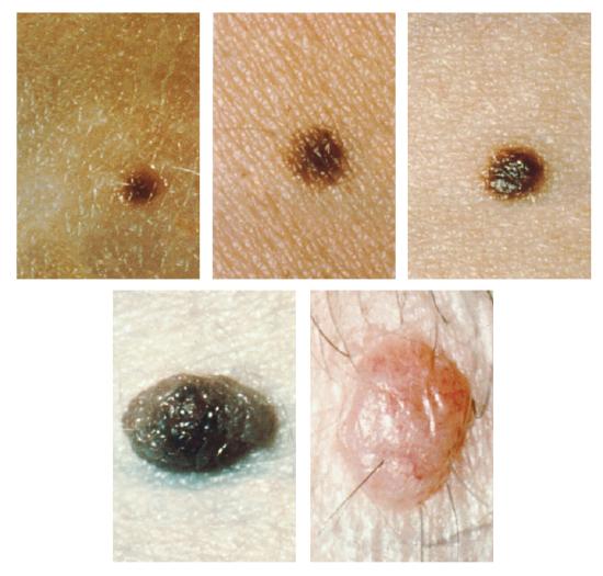Five images of skin moles