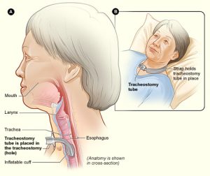 An elderly woman with a tracheostomy shown attached to her esophagus. A second image shows her laying in bed with the tracheostomy opening at the midpoint of her neck.