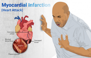 On the right, a man clutches his chest as he has a heart attack. On the left is a diagram of a heart that shows a blood vessel blocked by plaque.