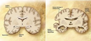 A brain with the hippocampus and entorhinal at the base of the brain, and cerebral cortex around the rest of brain labeled. On the left is a normal brain, and on the right is a depiction of a brain with Alzheimer's demonstrating extreme shrinkage in all areas.