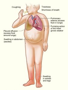 A diagram of the human body depicting swollen legs, fluid buildup in the lungs, weakened heartbeat, and coughing to demonstrate the symptoms of CHF.