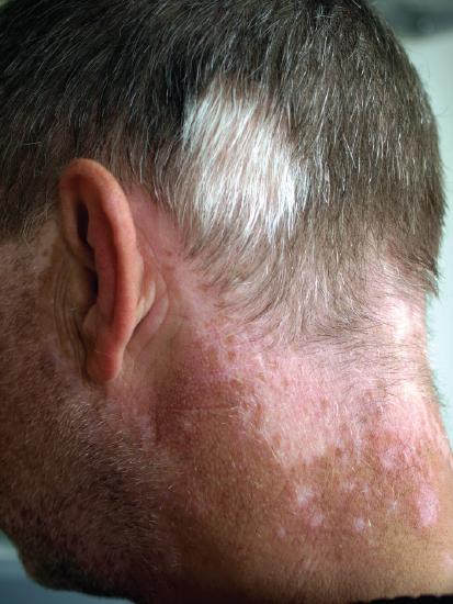 Back of man's head showing a white spot in the hair