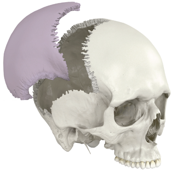 Parietal Bone Ex Situ
