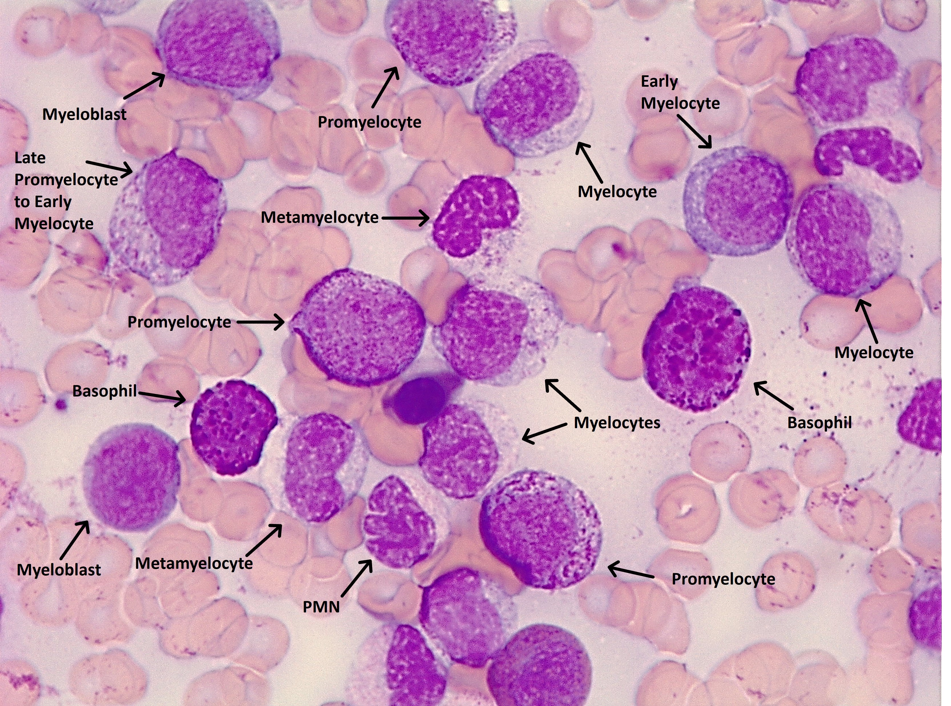 Basophils and immature granulocytes- compare to promyelocytes