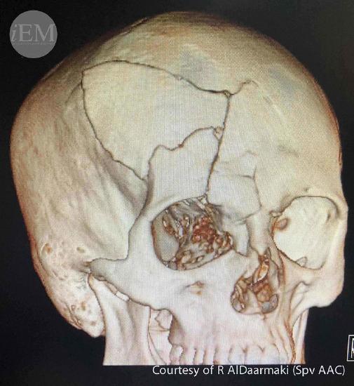 skull fracture.jpg