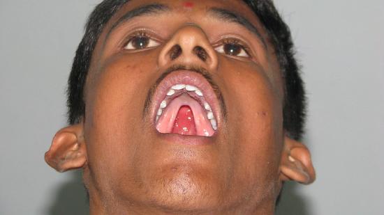 Cleft Palate Adult Photo