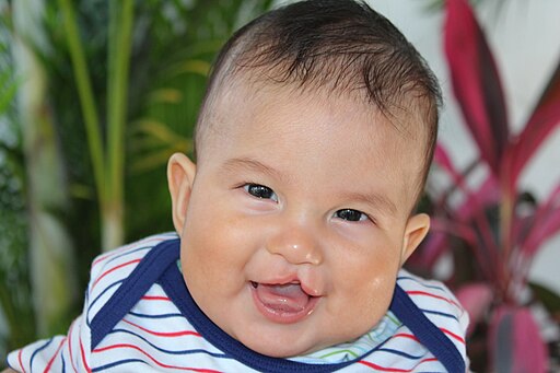 Cleft Lip Infant Photo