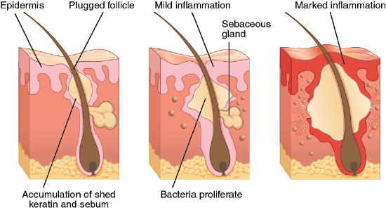 The process of acne formation - described in text