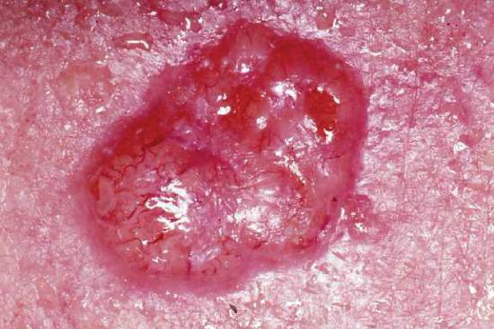 close up image of human skin with basal cell carcinoma