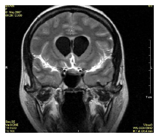 FLAIR MRI of meningitis