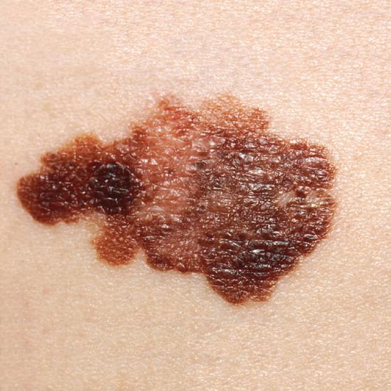 close up image of human skin with melanoma