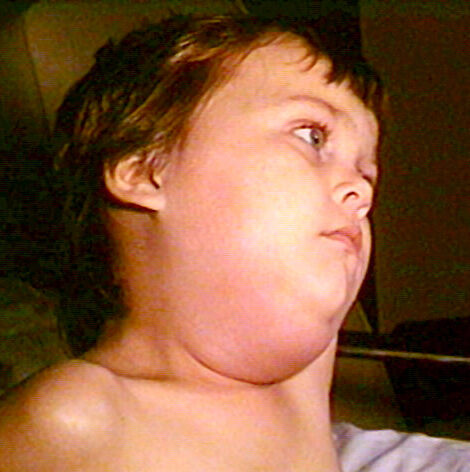 Mumps Face Rash 21.4: Mouth, Pharynx, and Esophagus - Medicine LibreTexts