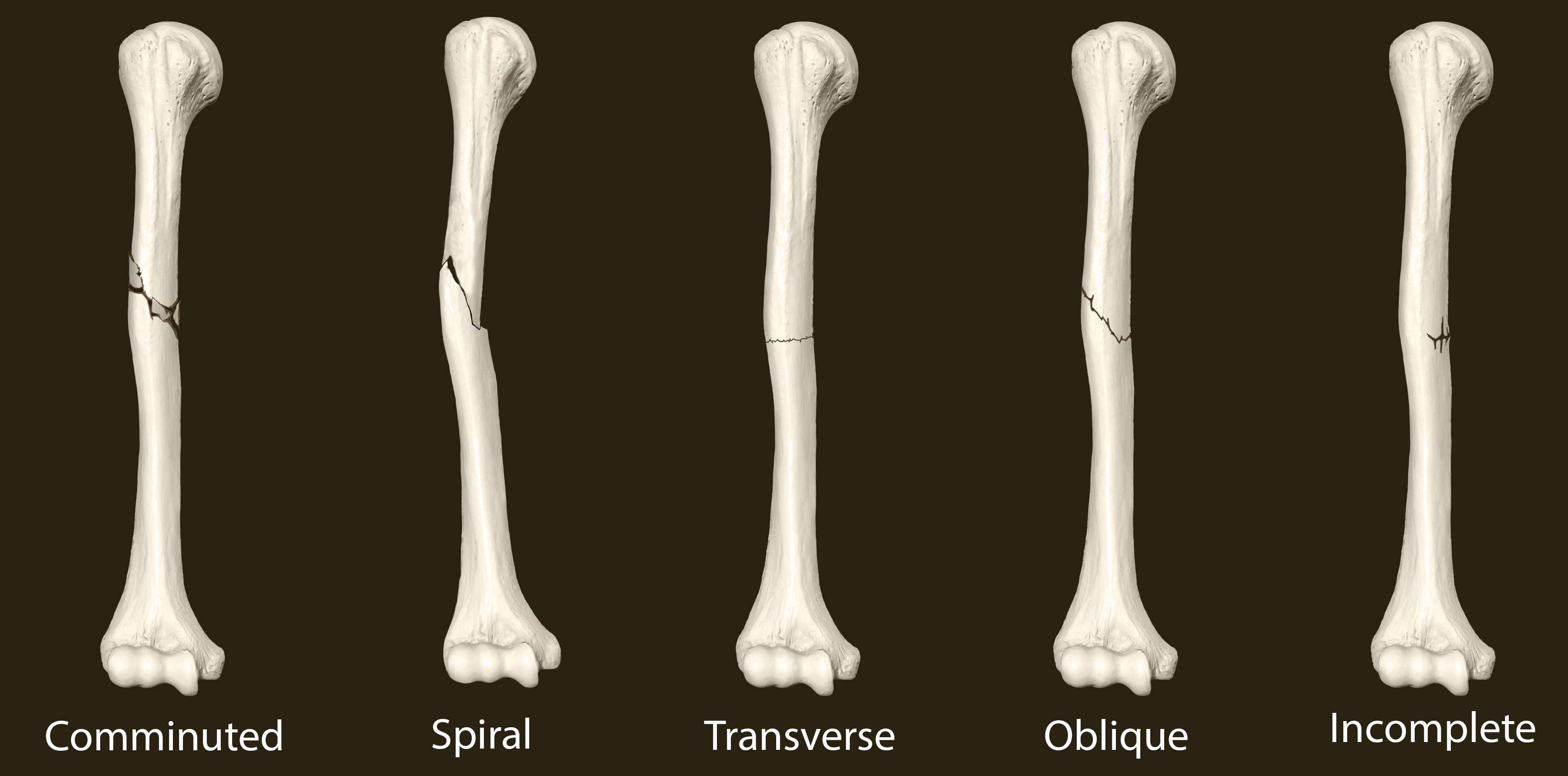Fracture Types.png