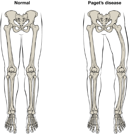 Normal skeleton from pelvis down next to skeleton from pelvis down with Paget's Syndrome