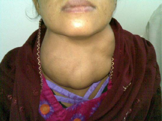 A woman with a goiter, which is an extreme, irregular swelling on the anterior side of the neck.