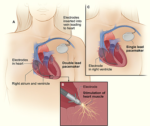 NIH pacemaker.jpg