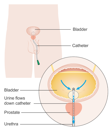 Diagram_showing_a_urinary_catheter_in_a_man.png