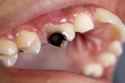 Picture of tooth decay or cavity.