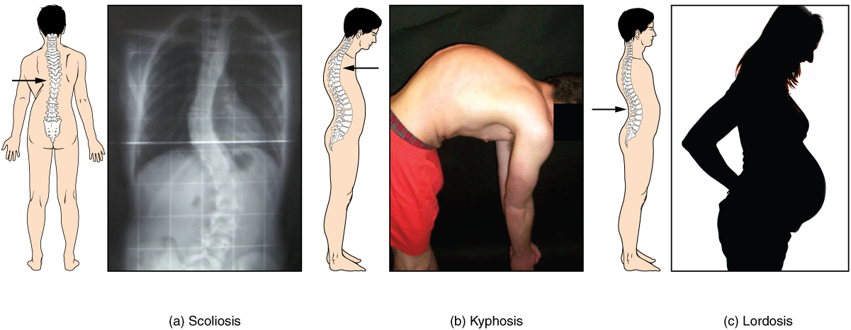 Michoro ya safu ya vertebral inayoonyesha curves ya scoliosis, kyphosis, & lordosis. X-rays ya wagonjwa wenye scoliosis na kyphosis.