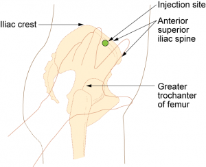 inyección intramuscular ventroglútea