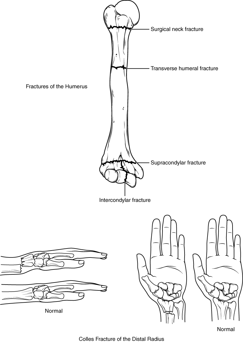 Various views of the arm bones and wrist showing fractures
