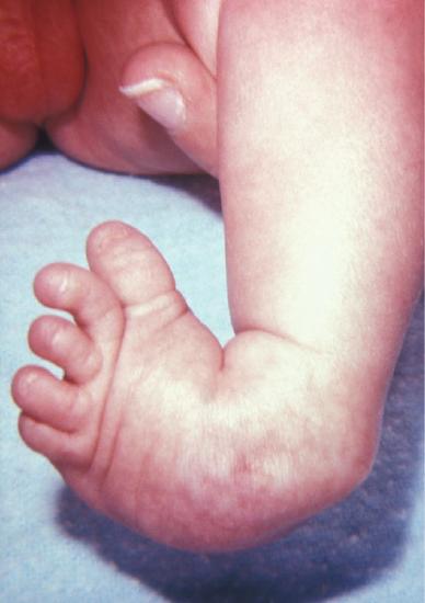 Lower limb of a newborn with clubfoot